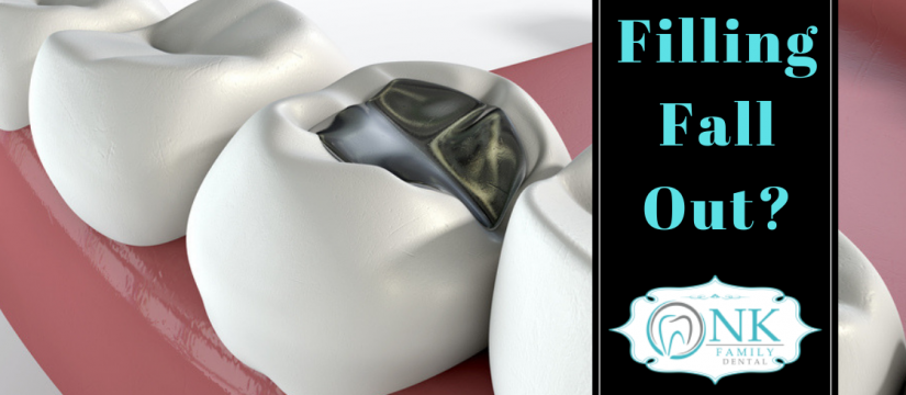Lost a filling, Filling fell out, when a tooth filling falls out, Chicago emergency dentist