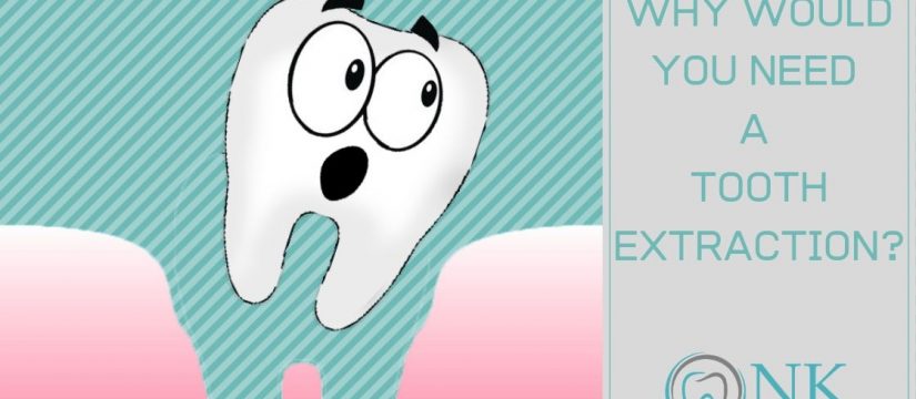 Tooth Extraction