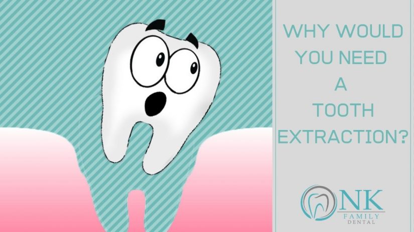 Tooth Extraction