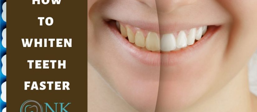 comparison of teeth and cleaning