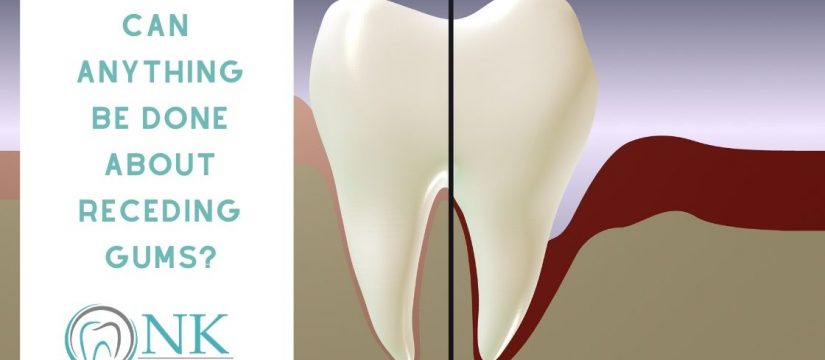 Gum recession