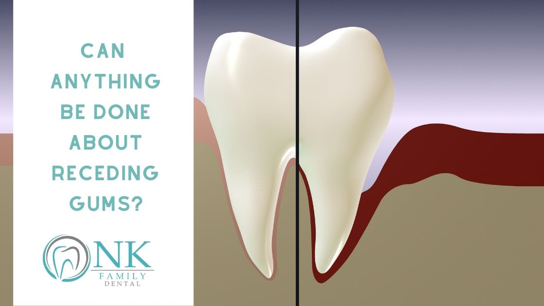 Can Anything Be Done about Receding Gums? NK Family Dental