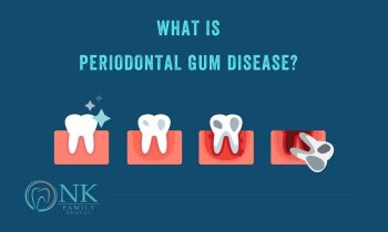 What is periodontal gum disease