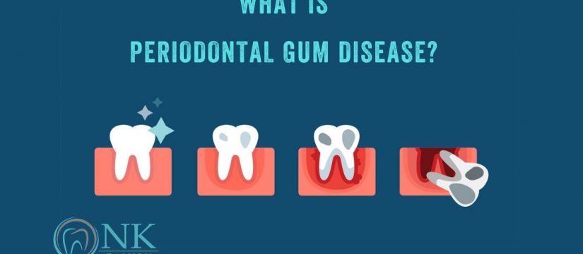 What is periodontal gum disease