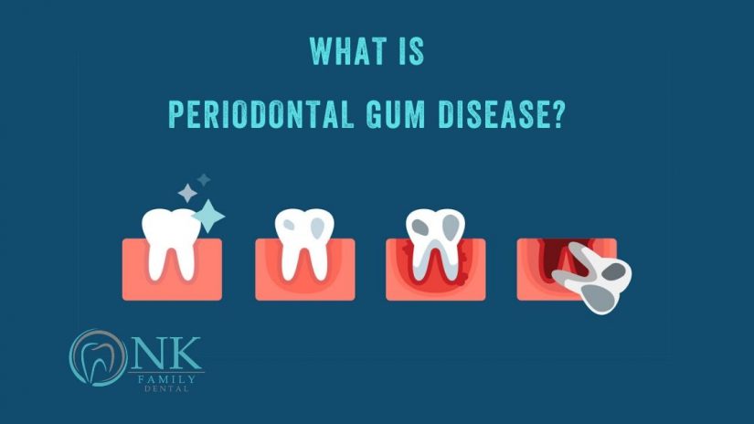 What is periodontal gum disease