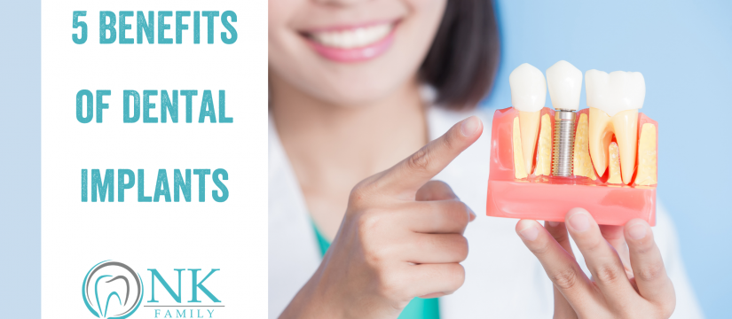 Benefits of Dental Implants