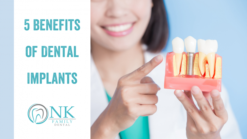 Benefits of Dental Implants