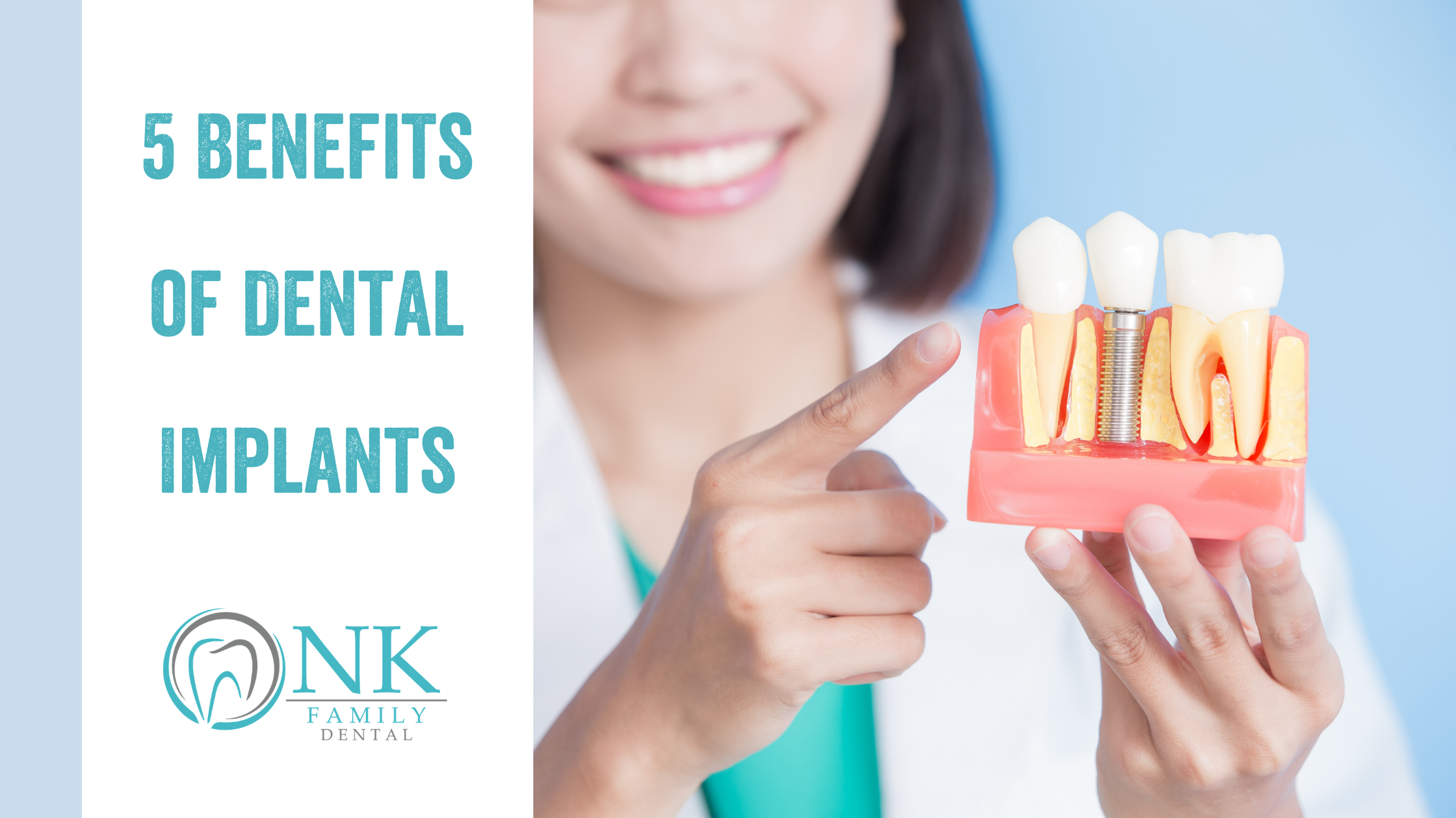 nk family dental blog 5 benefits of dental implants