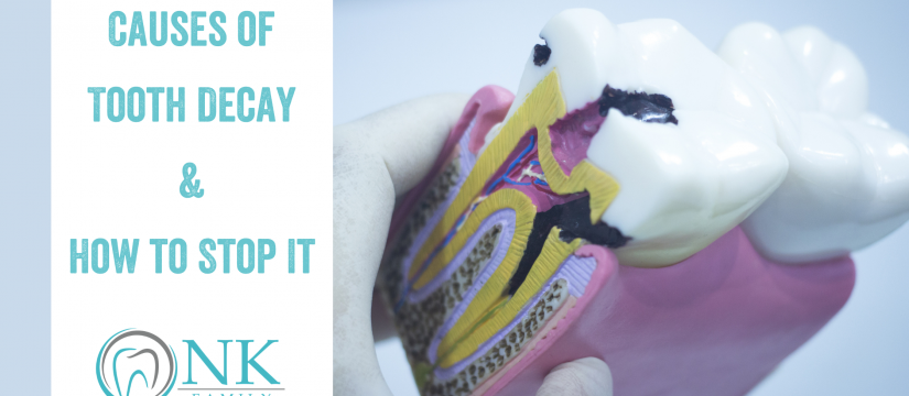 Causes of Tooth Decay & How to Stop It