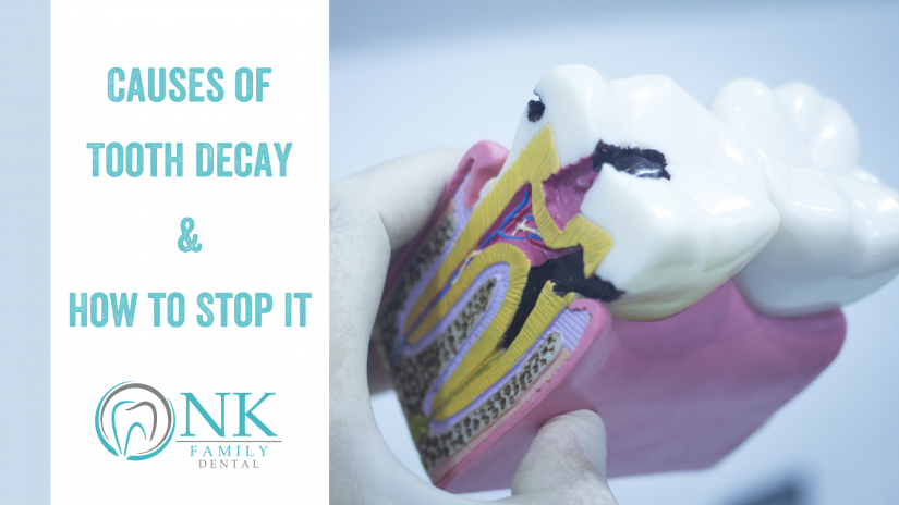 Causes of Tooth Decay & How to Stop It