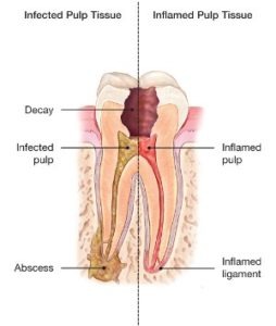 abscessed tooth root