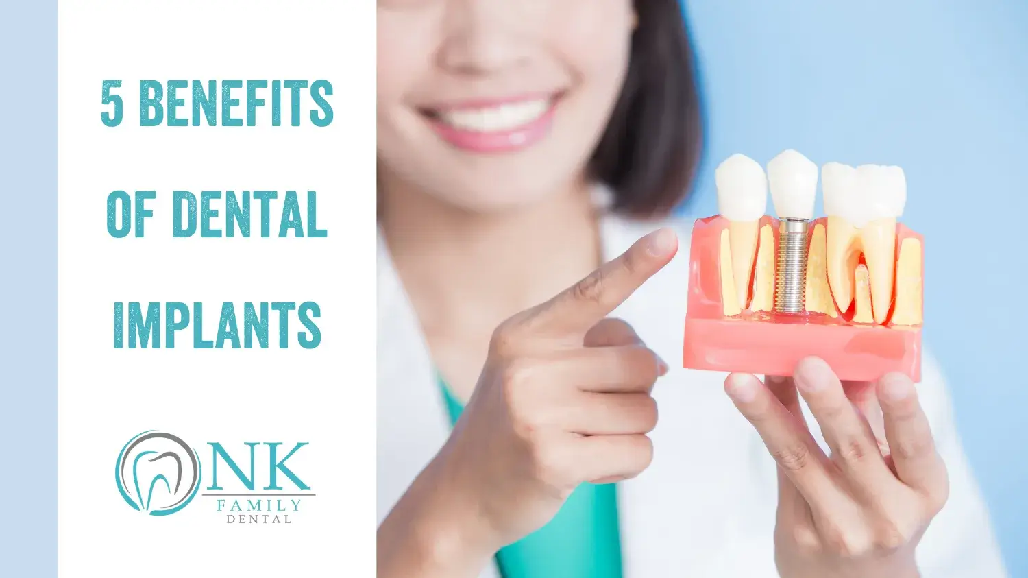nk family dental blog 5 benefits of dental implants