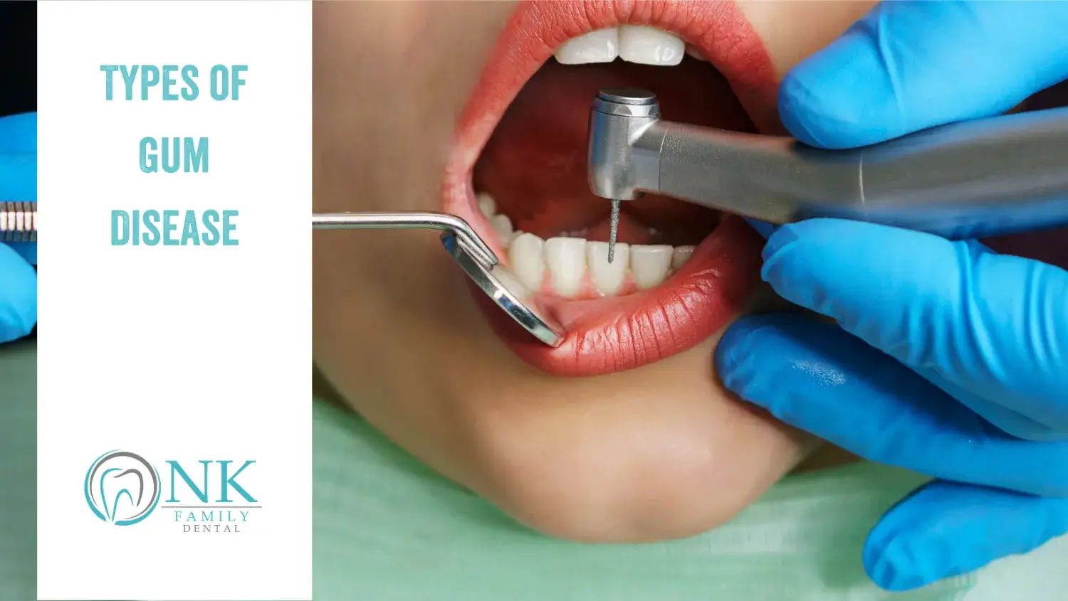 types of gum disease nk family dental blog 1 april2021 1
