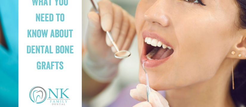 What You Need To Know About Dental Bone Grafts
