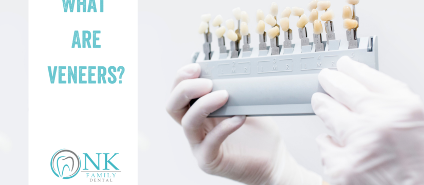 What Are Veneers?