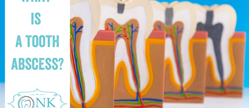 What Is A Tooth Abscess?