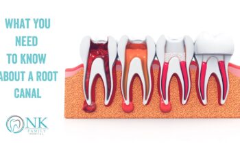 What You Need to Know About a Root Canal