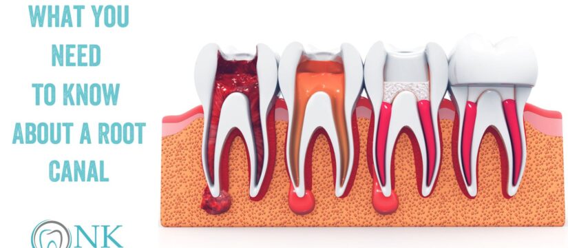 What You Need to Know About a Root Canal