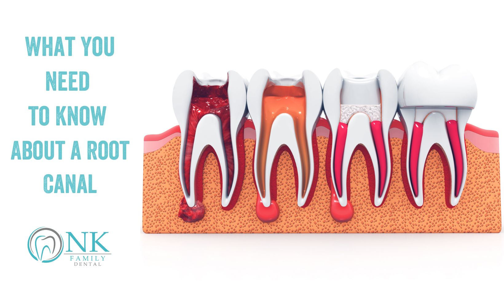 nk family dental december 2022 blog post 2