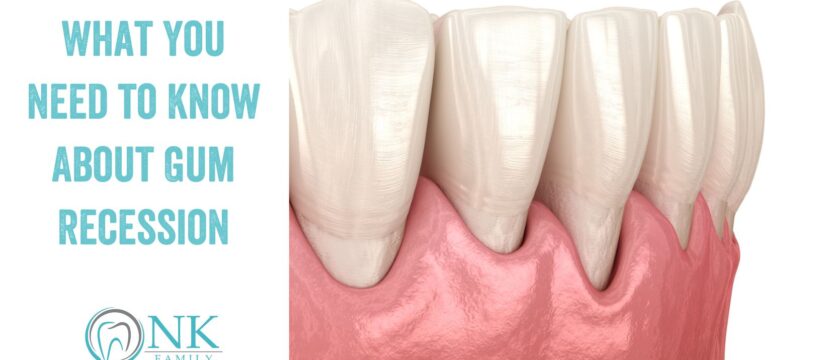 What You Need to Know About Gum Recession