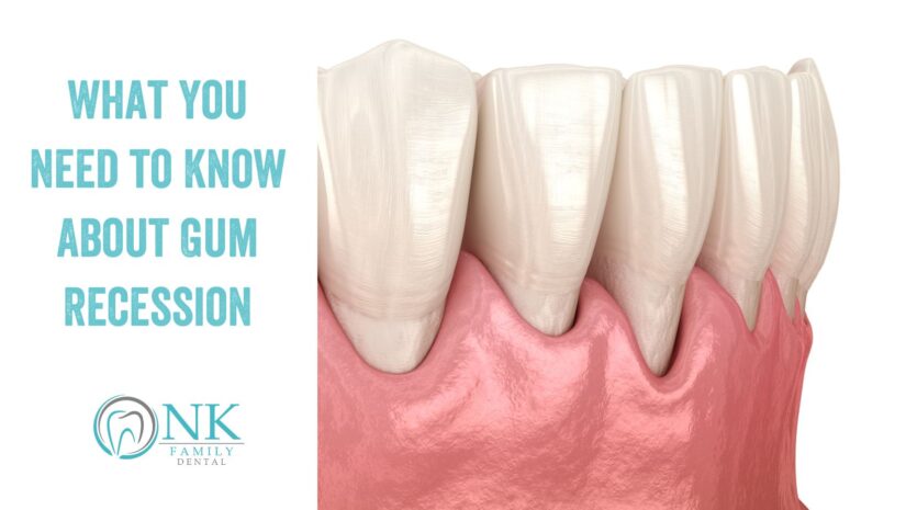 What You Need to Know About Gum Recession