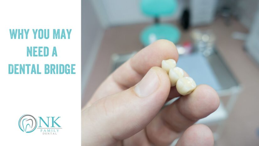 Why You May Need a Dental Bridge