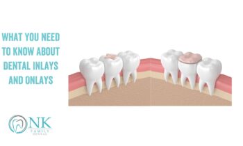 What You Need to Know About Dental Inlays and Onlays