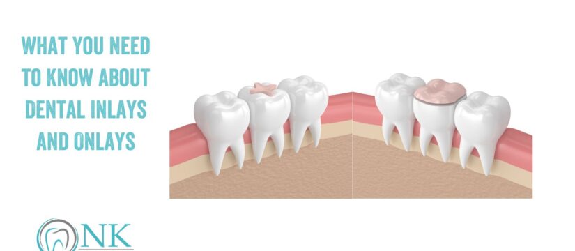 What You Need to Know About Dental Inlays and Onlays