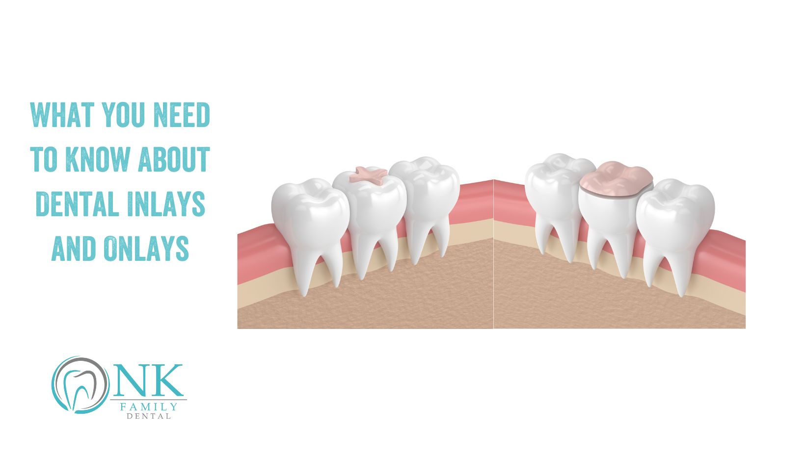 nk family dental blog #2 january 2024 inlays and onlays