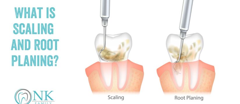What is Scaling and Root Planing?
