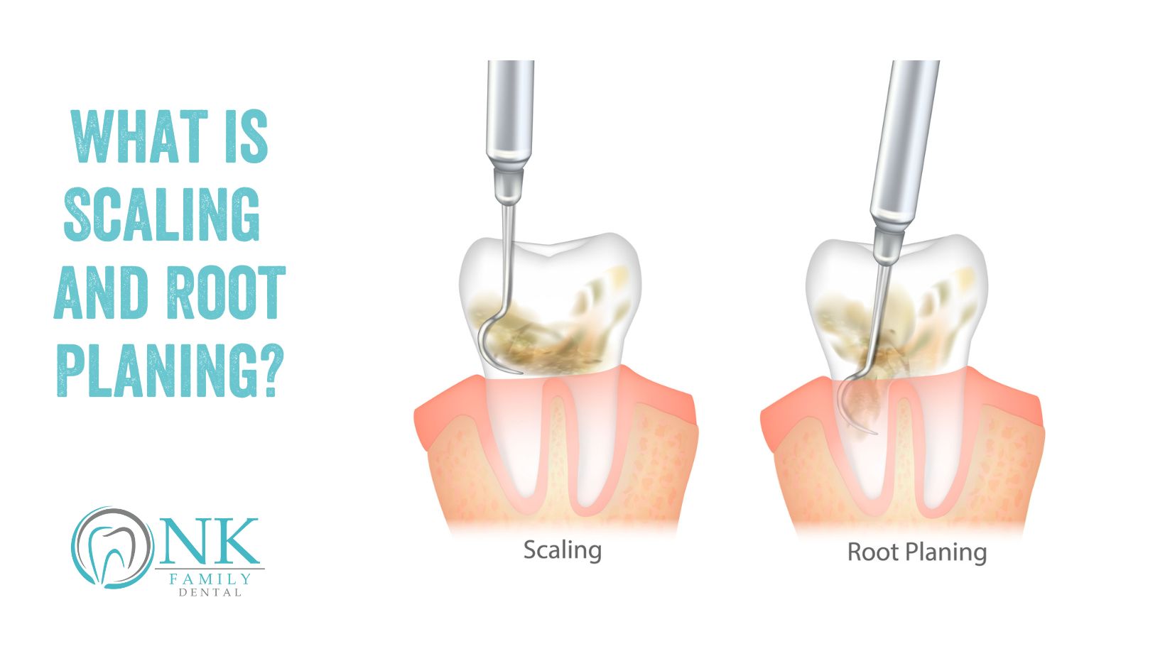 nk family dental april 2024 blog post 1 scaling