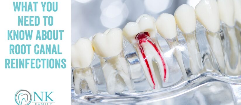 What You Need to Know About Root Canal Reinfections