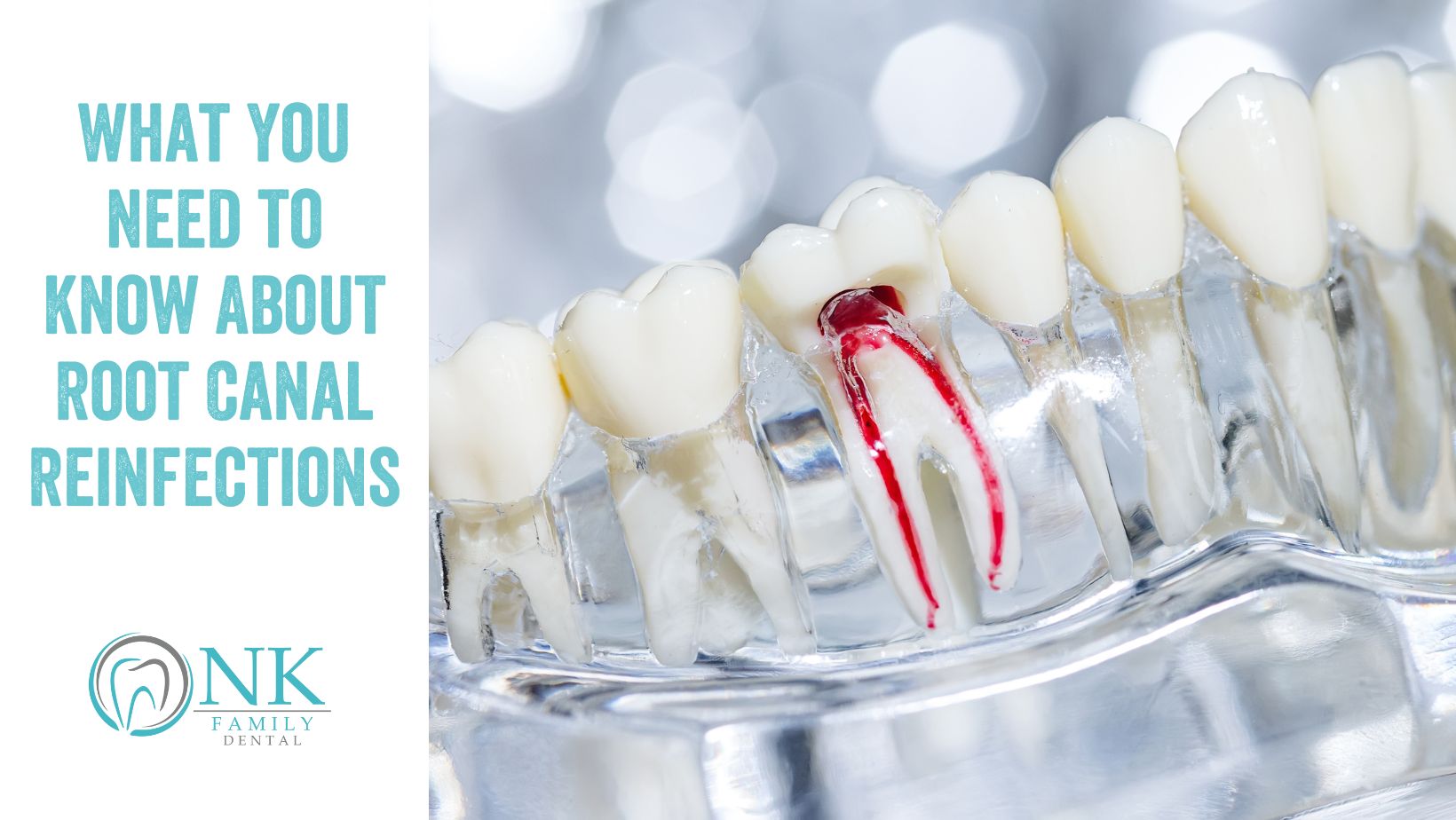 nk family dental june 2024 blog post 1 root canal