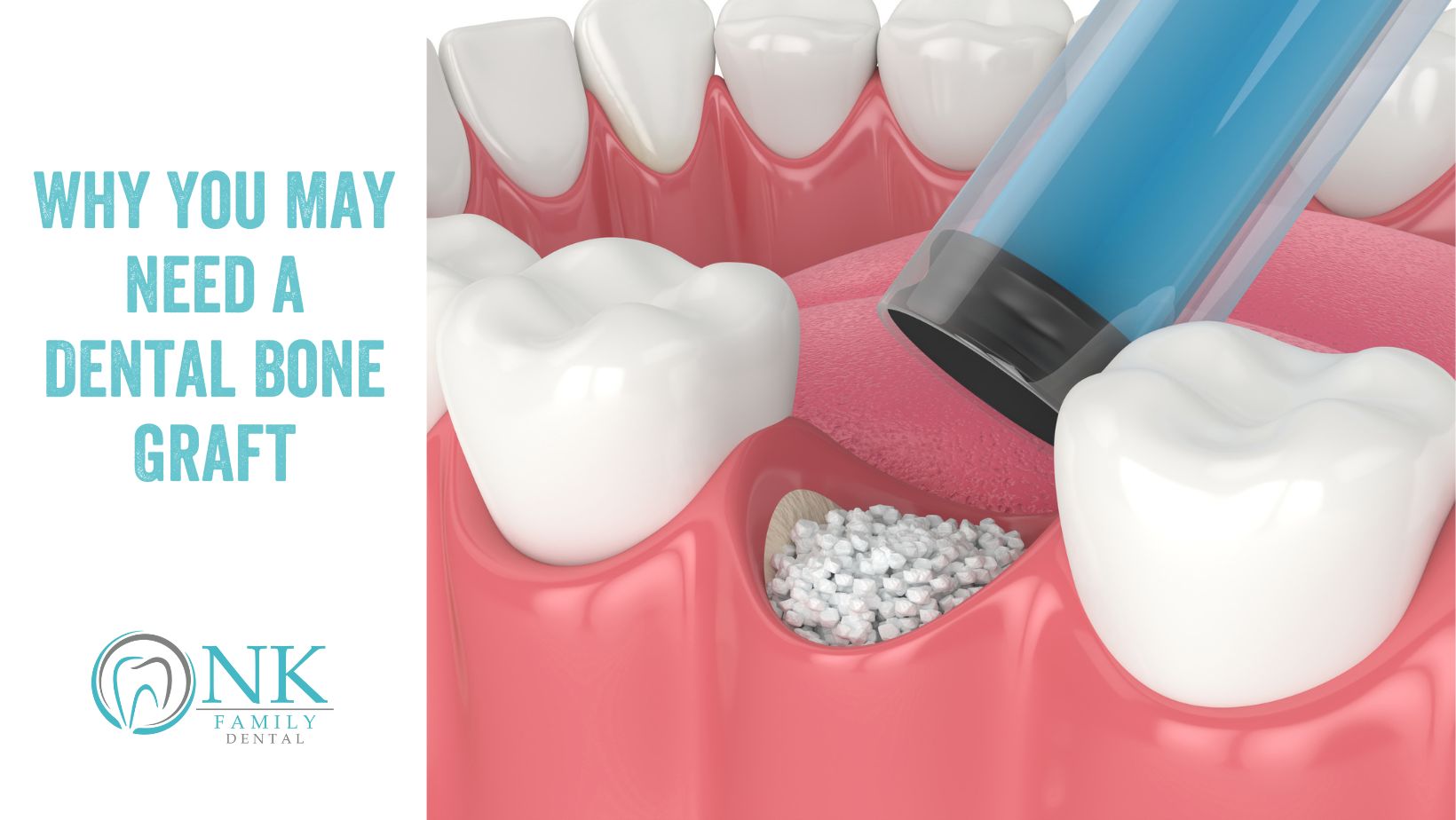 nk family dental august 2024 blog post 1 bone graft