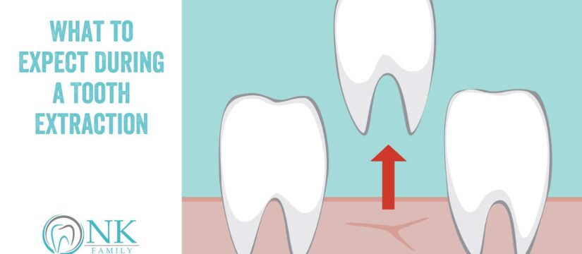 What to Expect During a Tooth Extraction