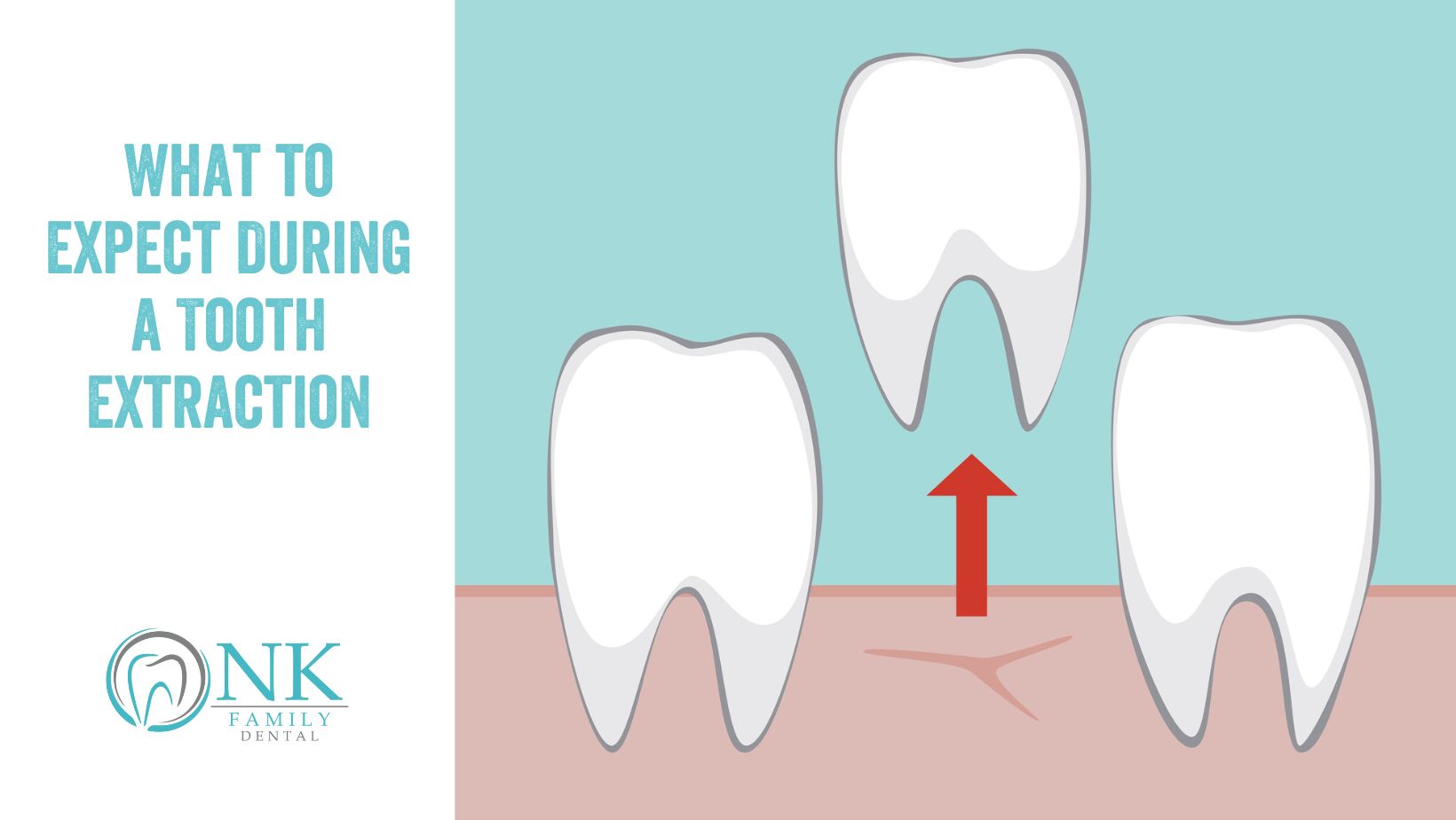 nk family dental december 2024 blog post 1 tooth extraction