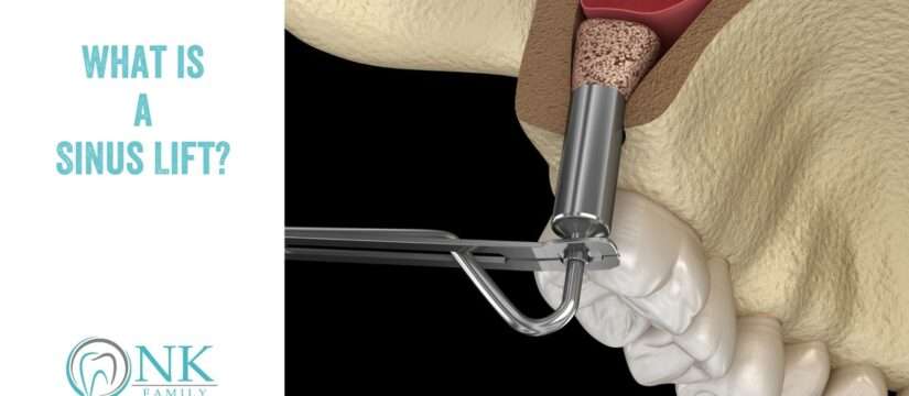 What is a Sinus Lift?