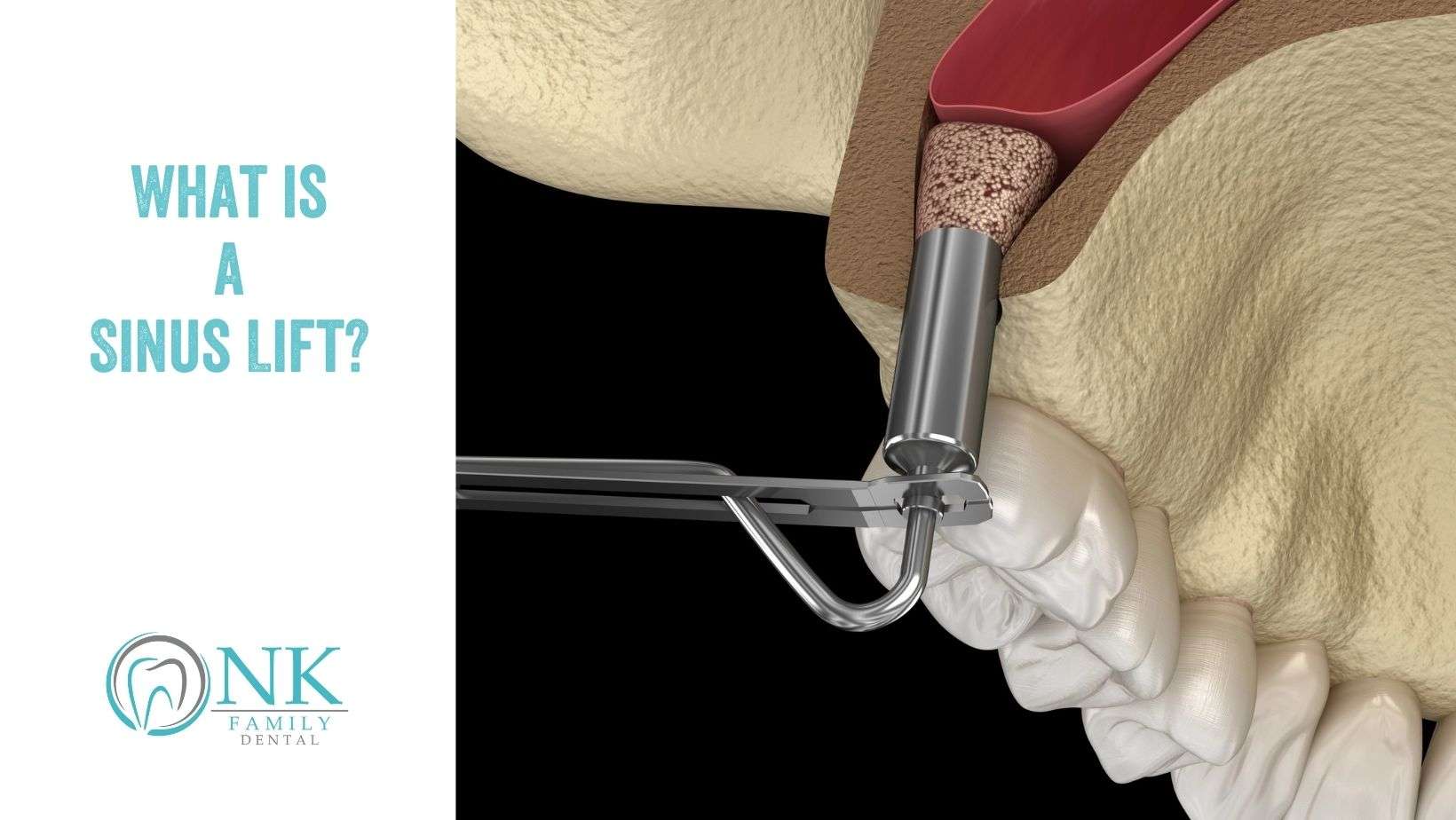 nk family dental march 2025 blog post 1 sinus lift