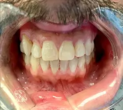 invisalign case 250x223 after