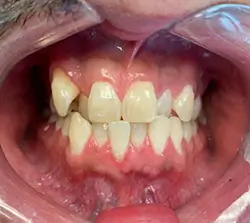 invisalign case 250x223 before