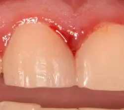 After Repairing a chipped front tooth