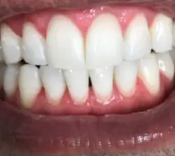 whitening after 250x223