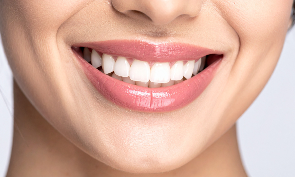Bright white smile after teeth whitening treatment showing improved tooth color
