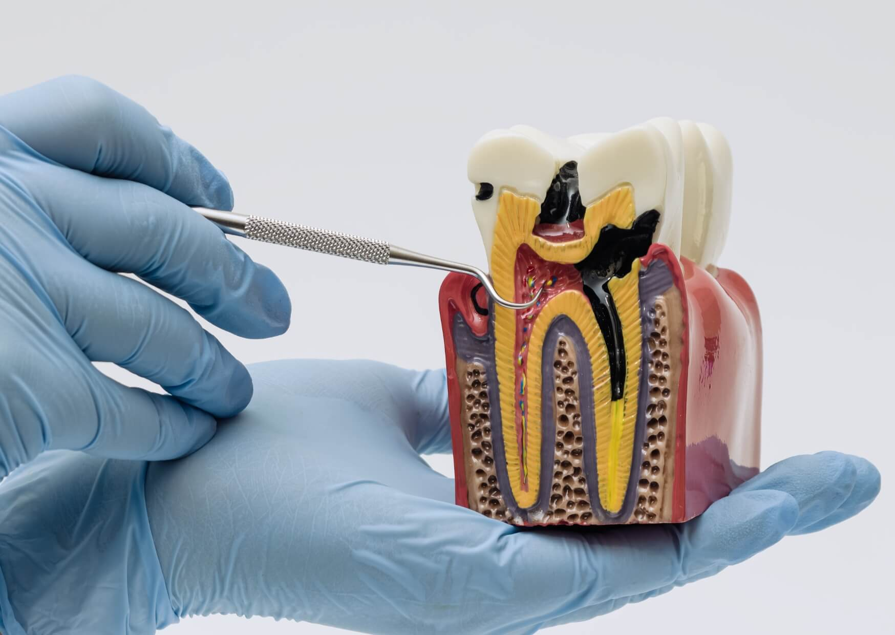 Dental model showing tooth decay progression and cavity development, illustrating why cavities typically do not heal on their own once enamel damage occurs.