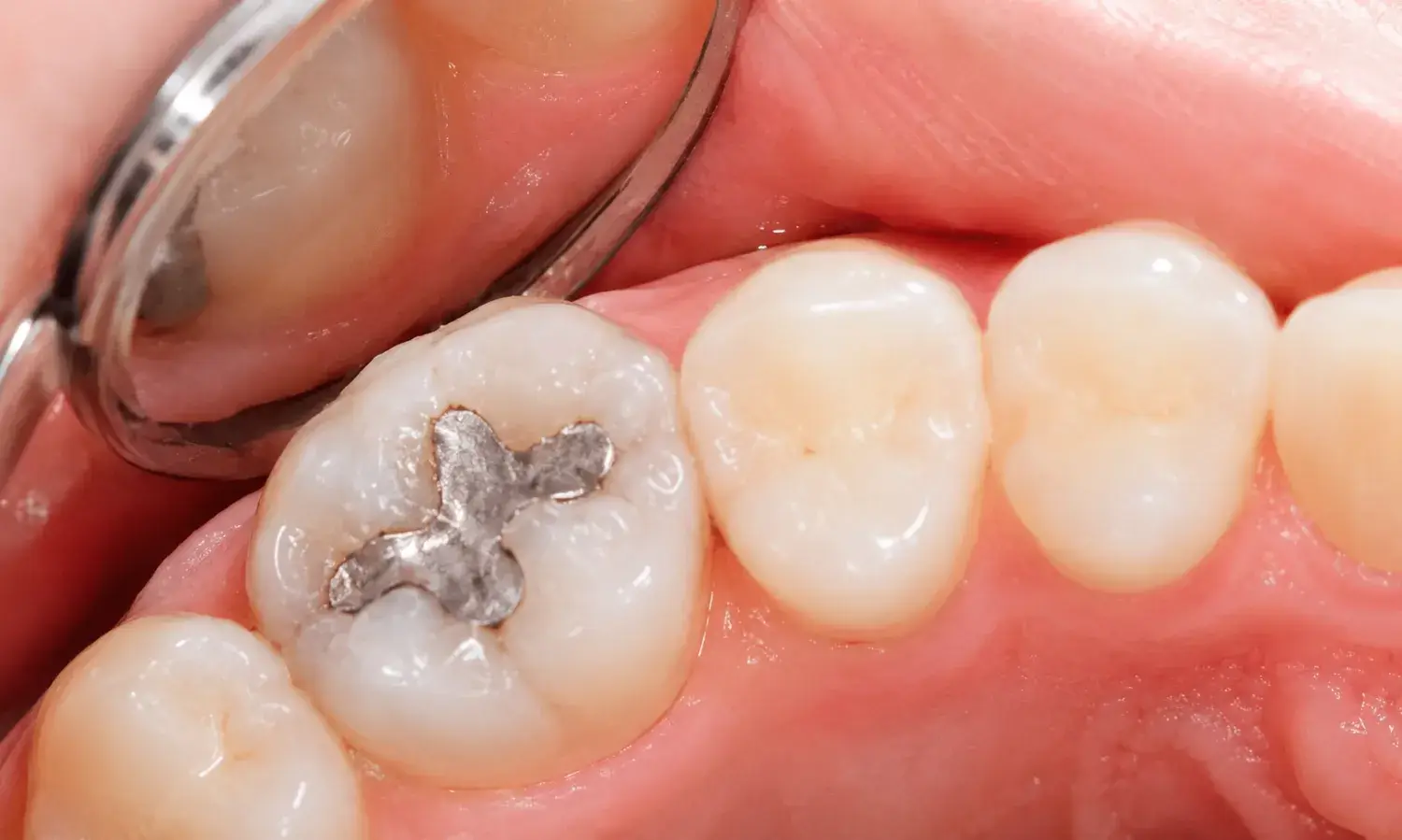 composite fillings 2 