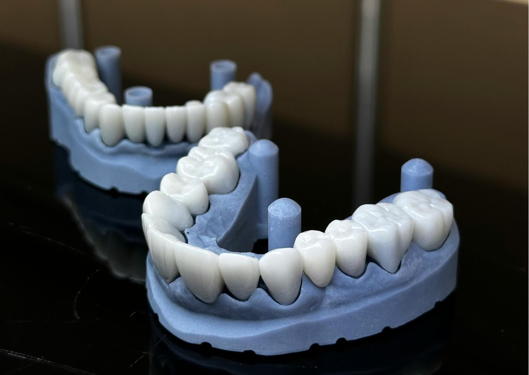 Dental models displaying porcelain veneer restorations, illustrating the durable materials used to support long-term veneer longevity.