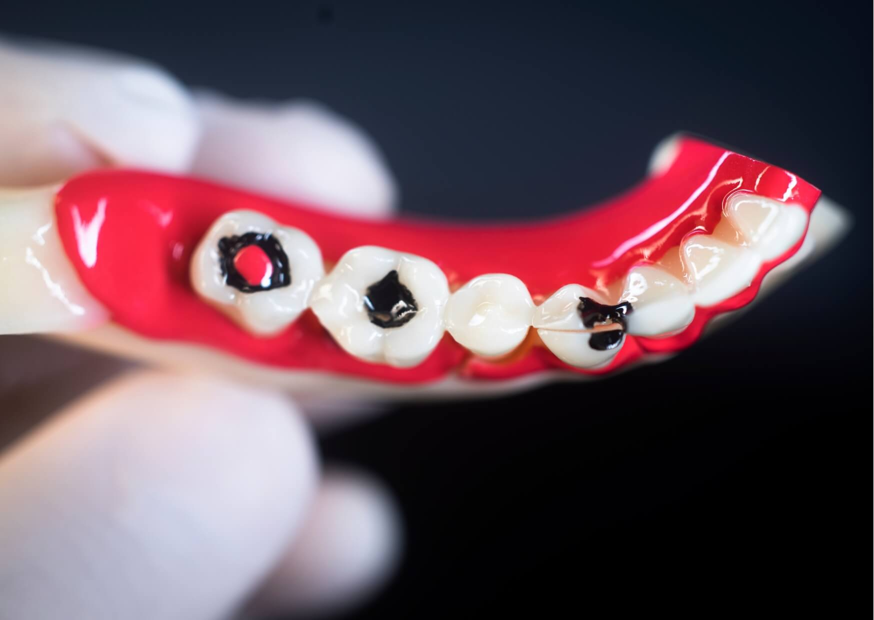 Dental model showing advanced tooth decay with dark cavities, damaged teeth, and a broken tooth to illustrate what a rotten tooth looks like.