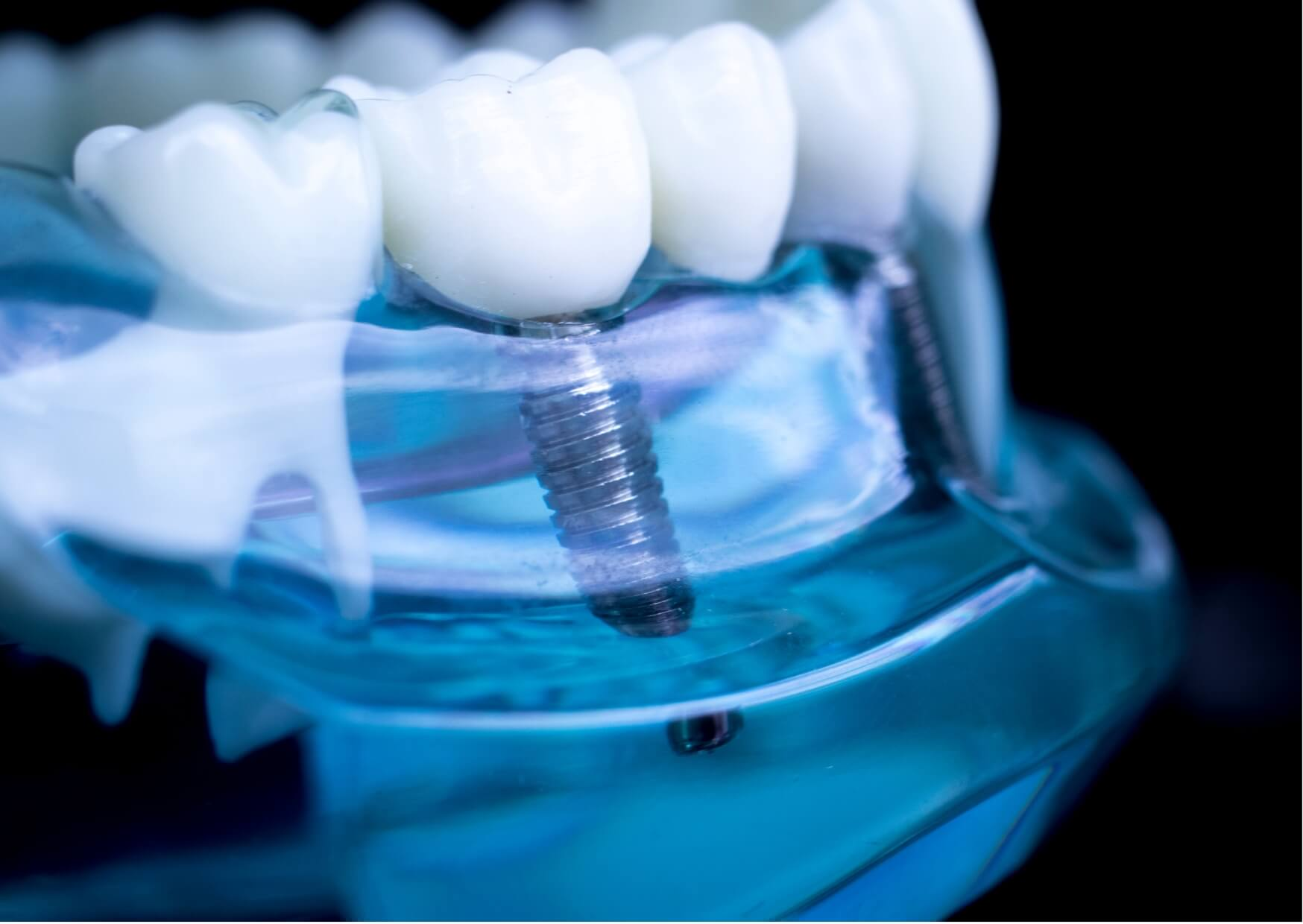 Dental implant model showing an implant-supported crown replacing a missing tooth, illustrating how dental implants can restore missing teeth even after tooth loss.
