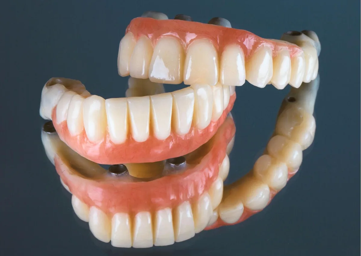 Full mouth dental implant restoration showing implant-supported upper and lower arches.