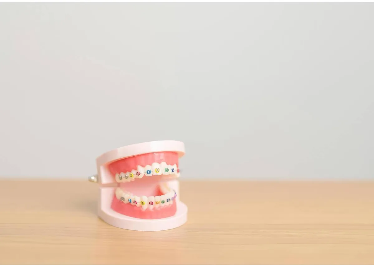 Dental model with traditional metal braces used to explain braces cost and treatment.